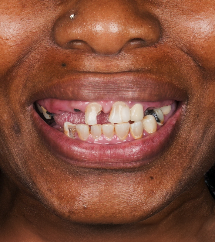 Implants + All-On-X — Before